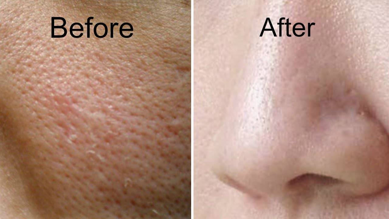 get rid of large pores instantly
